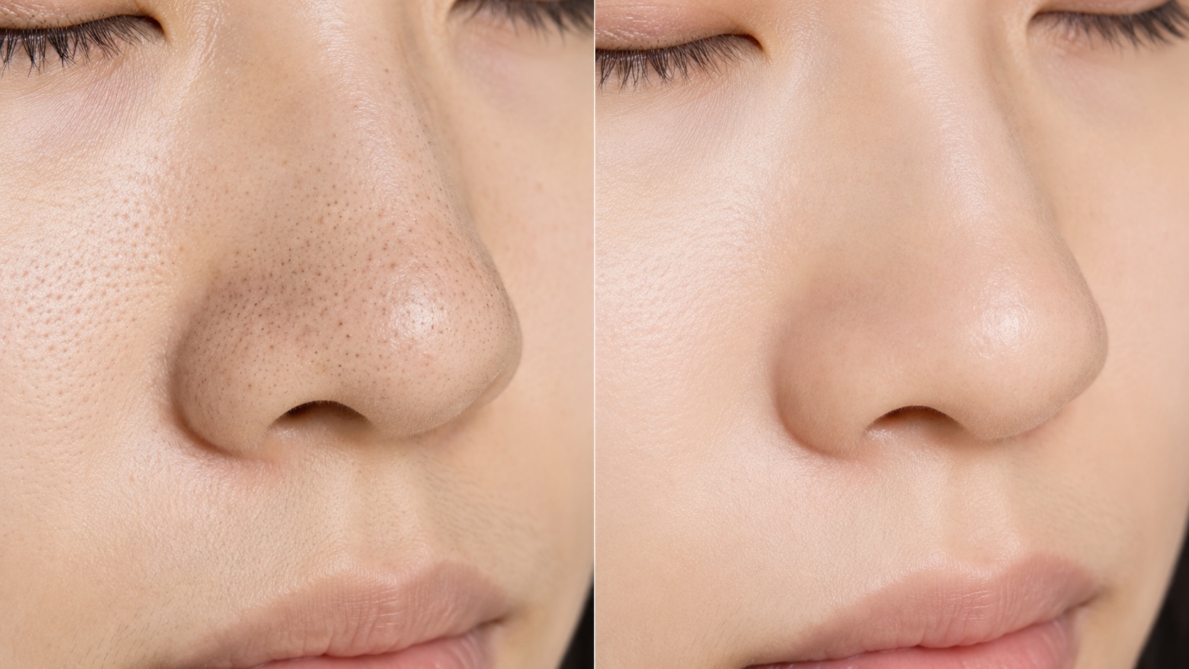 Before and after comparison of skin pore appearance and clarity after 6 weeks of Banila Co Clean It Zero Cleansing Balm double cleanse