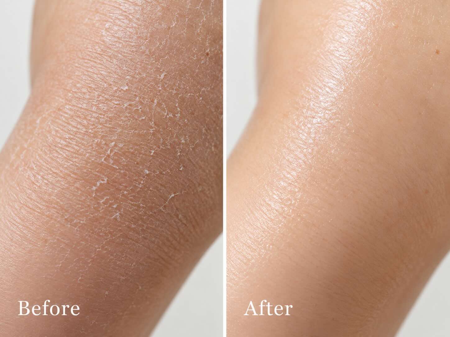 Before and after using Hearth and Homestead Whipped Beef Tallow Balm — dry flaky skin vs soft smooth skin after 2 weeks of nightly use